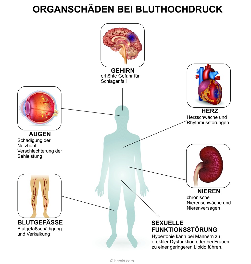 Grafik Organschäden bei Bluthochdruck